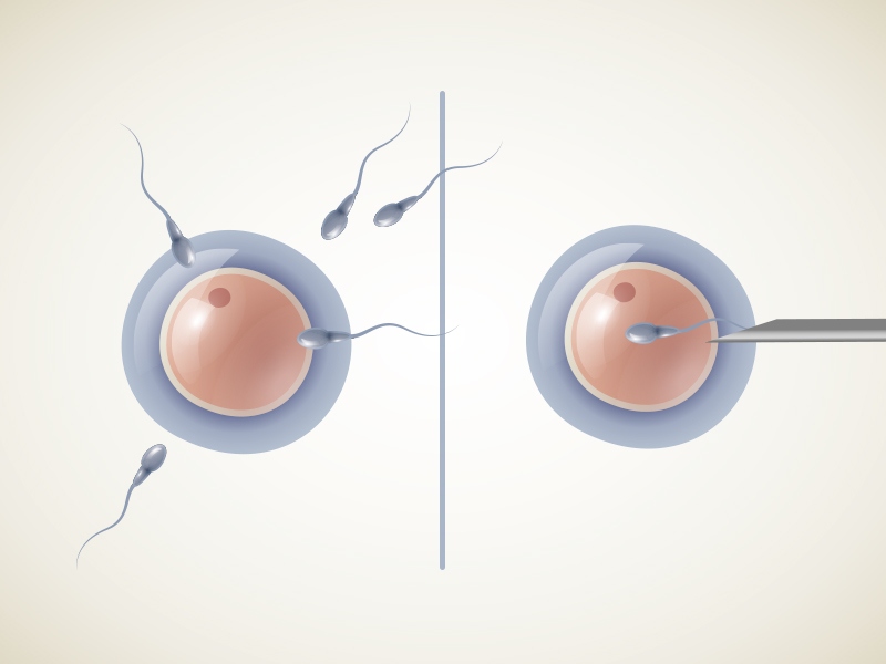 Diferencia entre FIV e ICSI